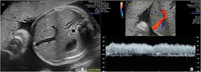 Value of foetal umbilical vein standardised blood flow volume in predicting weight gain in the third trimester: a prospective case-cohort study